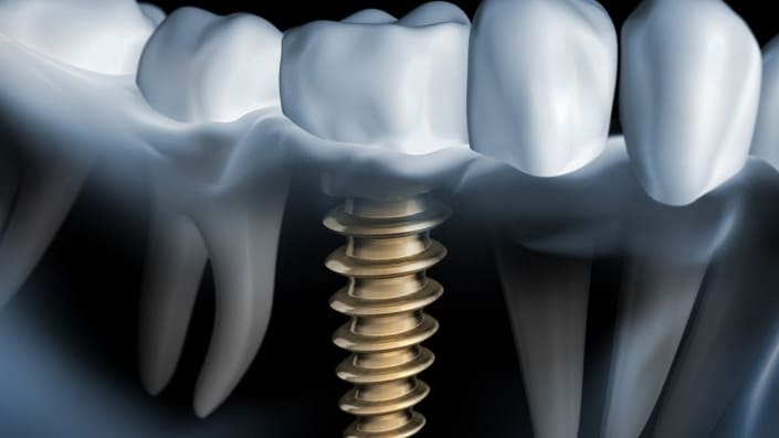 Implantate sind künstliche Zahnwurzeln bei Zahnersatz kompetente Beratung Zahnarztpraxis Altona